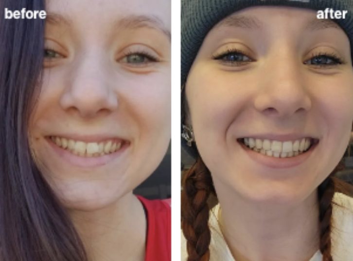 Prije i poslije Invisalign terapije — primjer iz službene Invisalign galerije (Align Technology). Osobe nisu pacijenti ovog portala; rezultat ovisi o polaznom stanju i disciplini nošenja.