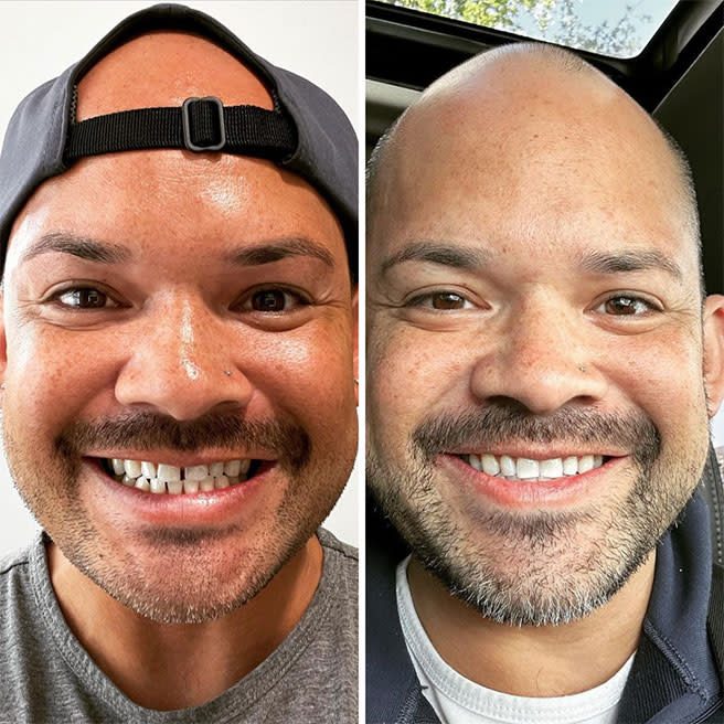 Prije i poslije Invisalign terapije — primjer iz službene Invisalign galerije (Align Technology). Osobe nisu pacijenti ovog portala; rezultat ovisi o polaznom stanju i disciplini nošenja.