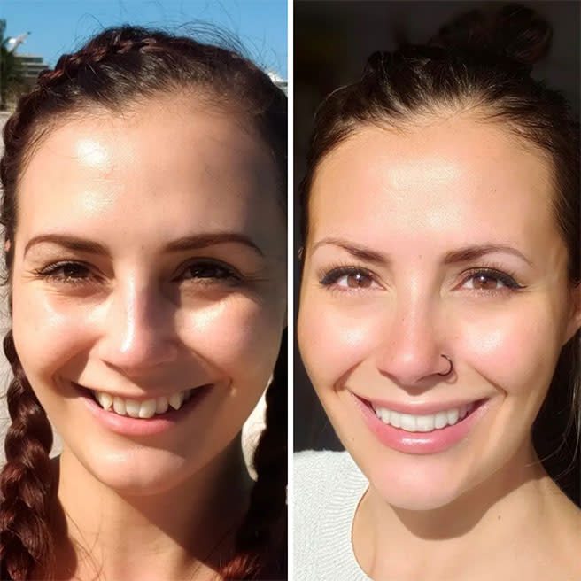 Prije i poslije Invisalign terapije — primjer iz službene Invisalign galerije (Align Technology). Osobe nisu pacijenti ovog portala; rezultat ovisi o polaznom stanju i disciplini nošenja.