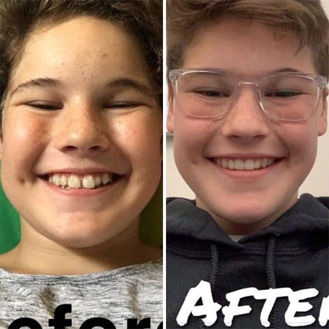Prije i poslije Invisalign terapije — primjer iz službene Invisalign galerije (Align Technology). Osobe nisu pacijenti ovog portala; rezultat ovisi o polaznom stanju i disciplini nošenja.